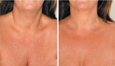 Rimedi naturali per attenuare le rughe del collo