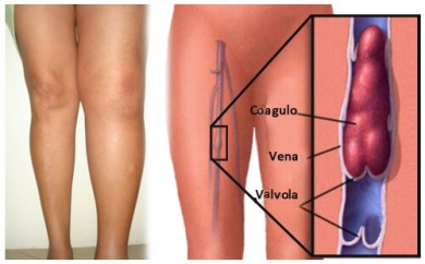 Trombosi venosa e come prevenirla in 5 modi