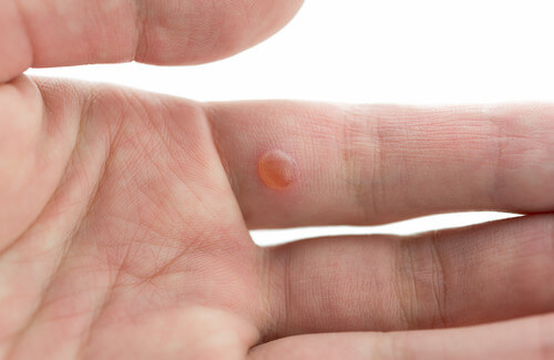 vescicola su mano