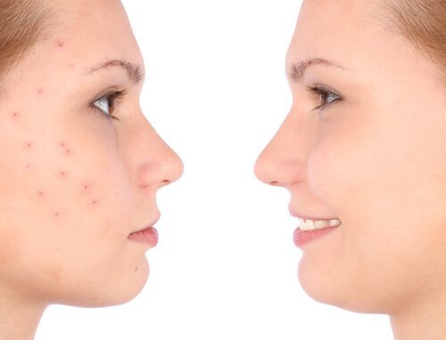 Acne sul viso