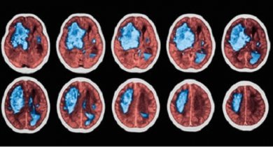 Come prevenire un'emorragia cerebrale