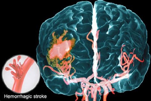 ictus emorragico