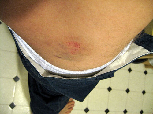 Come curare i lividi