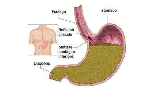 Disegno dello stomaco con reflusso gastroesofageo