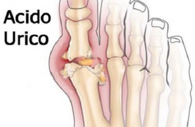 Acido urico: come ridurlo nel corpo.