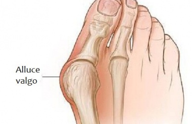 L'alluce valgo: perché si forma e come trattarlo?