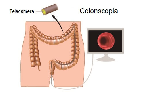 Colonscopia