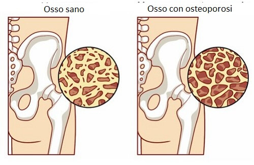 Alimenti che prevengono l'osteoporosi eccone 8