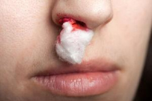 Sangue dal naso: cosa fare quando succede?