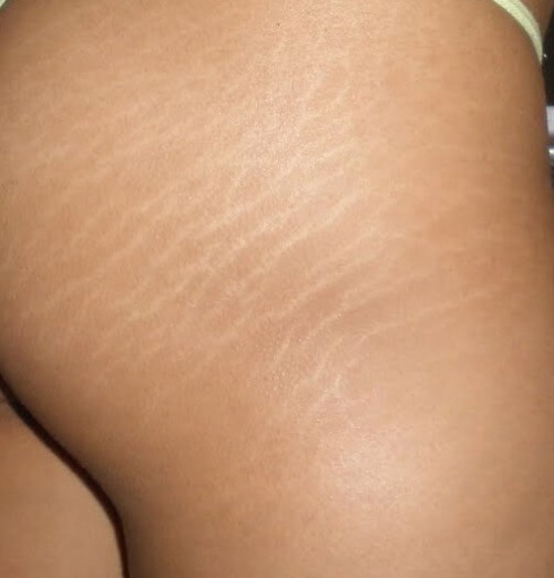 smagliature sulla pelle