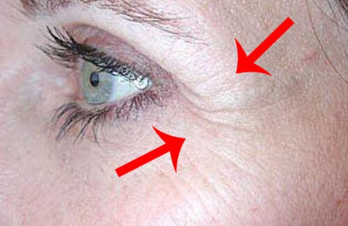 correggere zampe di gallina