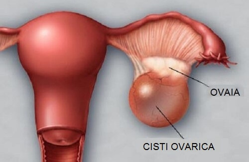 Prevenire ed individuare le cisti nelle ovaie