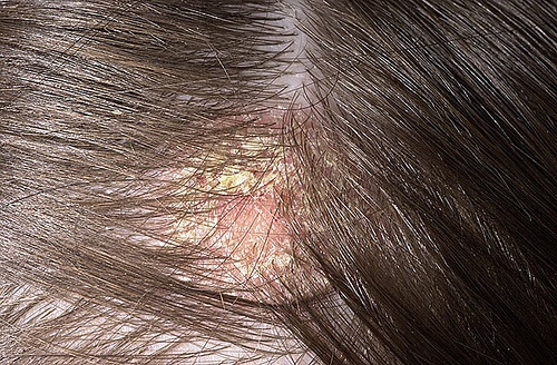 Per contrastare la dermatite seborroica esistono numerosi rimedi naturali