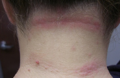 Trattamenti efficaci per contrastare la dermatite seborroica