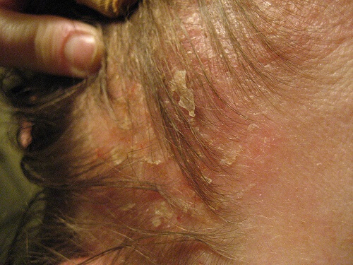Tra i rimedi per eliminare la dermatite seborroica c'è senza dubbio quello di seguire una dieta sana ed equilibrata