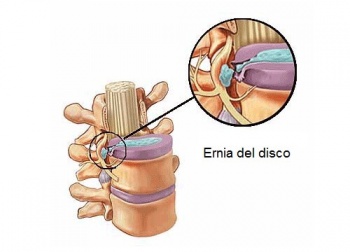 Ernia del disco: cause e sintomi