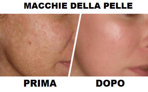 macchie della pelle
