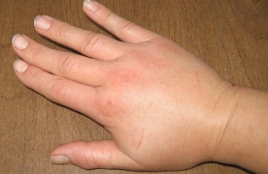 Come alleviare la ritenzione idrica in modo naturale