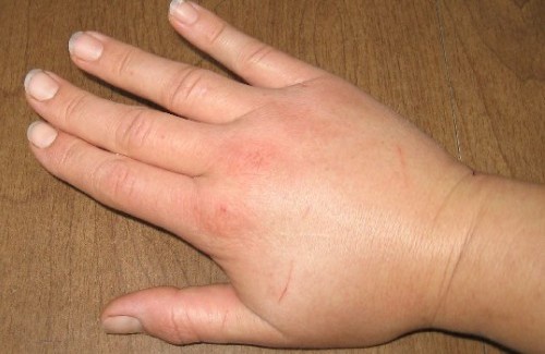 Mano gonfia per ritenzione