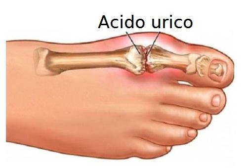 Ridurre l'acido urico