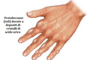 Come ridurre l'acido urico