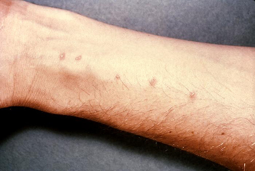 Dermatite allergica da contatto