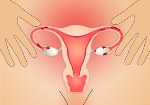 Trattare l'endometriosi con l'alimentazione