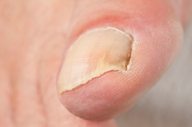 Malattie delle unghie: come trattare le più comuni?