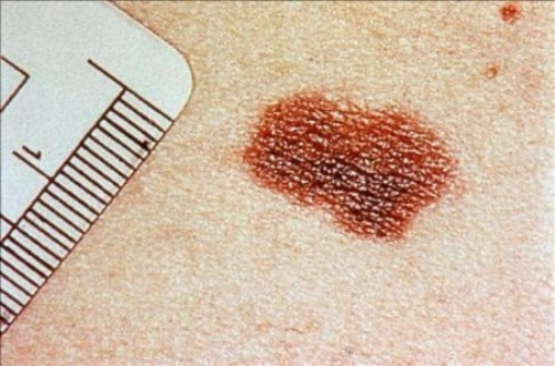Tumore della pelle