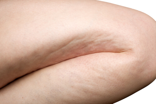 Combattere la cellulite in modo naturale