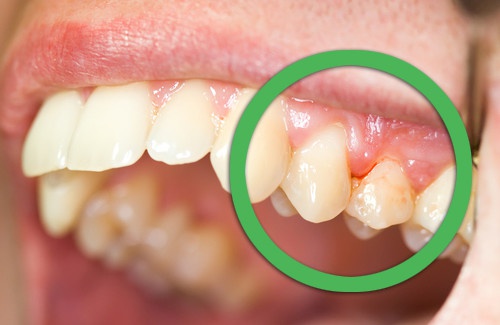 il mal di denti può essere provocato da un'infezione delle gengive