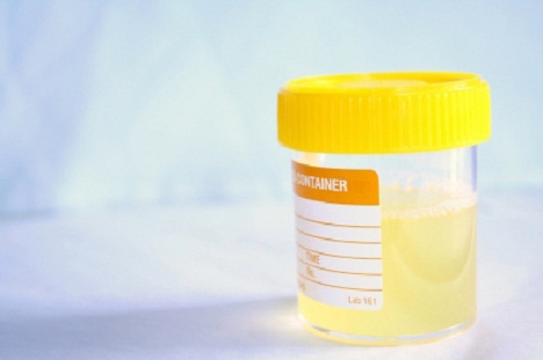 Infezioni del tratto urinario e rimedi fatti in casa