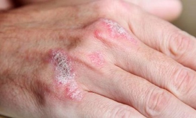Rimedi naturali contro i sintomi della psoriasi