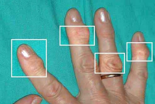 Contrastare l’artrite con rimedi naturali