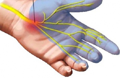 Rimedi naturali per la sindrome del tunnel carpale