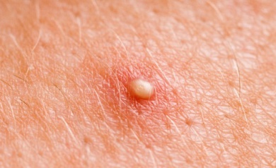 Rimedi fai da te per i foruncoli