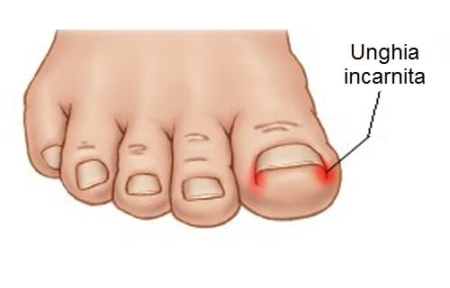 Unghia incarnita