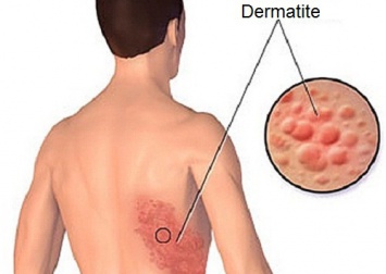Fuoco di Sant'Antonio: rimedi naturali