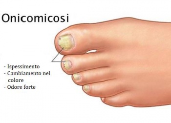 Funghi delle unghie: quando le unghie diventano gialle