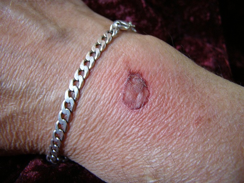 ustione di primo grado