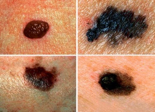 Uno dei segnali d'allarme dei tumori della pelle è senz'altro la comparsa di un nuovo neo con determinate caratteristiche