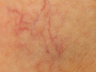 9 modi per prevenire i capillari visibili sulle gambe