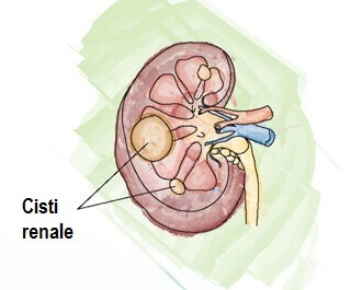 disegno del rene con cisti renali