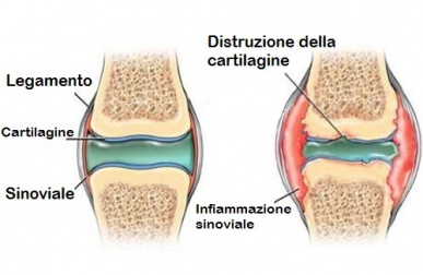 Dolore alle cartilagini e come prevenirlo