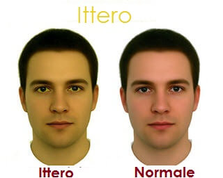 La pelle: ittero