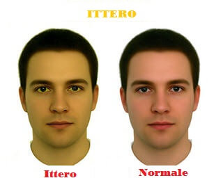 Viso maschile con ittero e viso normale