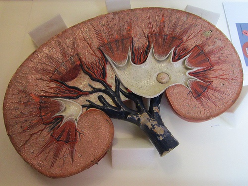 modello in sezione di un rene con cisti renale