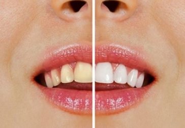 Come avere denti splendenti con prodotti naturali