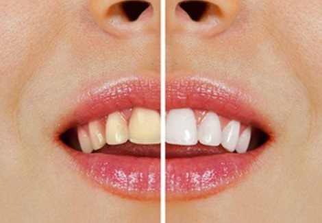 Come sbiancare i denti con prodotti naturali Come sbiancare i denti con prodotti naturali