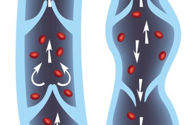Rimedi contro le vene varicose, ecco i migliori 10